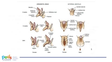 intersex gentiles|External Genitalia of an Intersex Individual